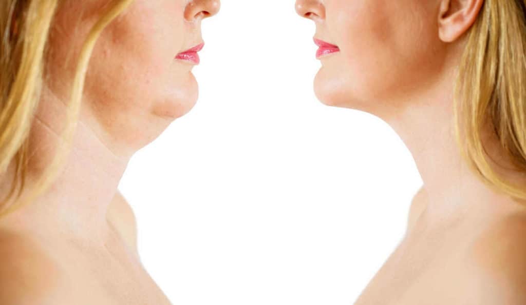 Double Chin treatment Matlock before and after results