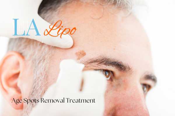 What Are the Most Effective Treatments for Age Spots Matlock?