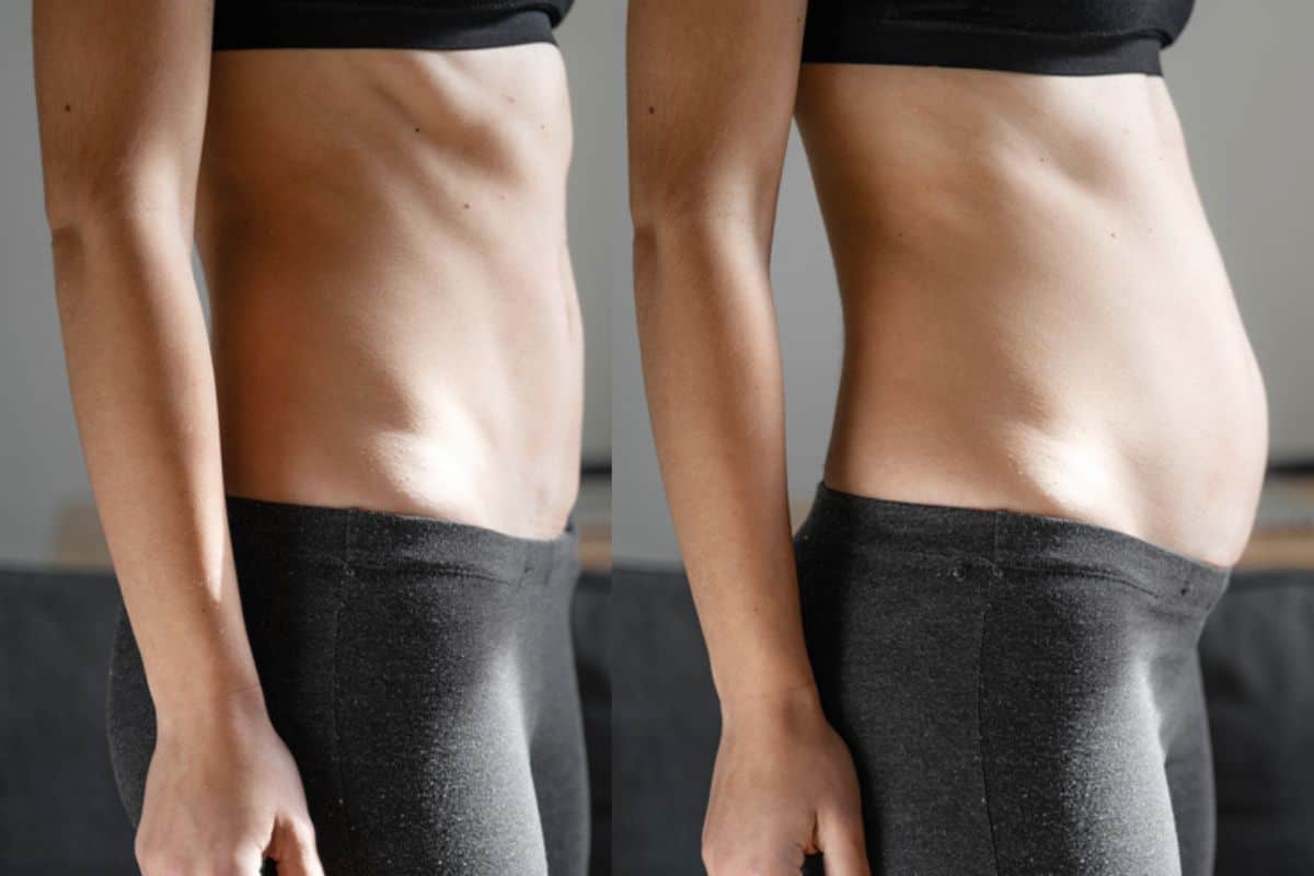 How long does diastasis recti take to improve Matlock?