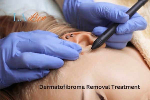 Dermatofibroma Removal Treatment Matlock