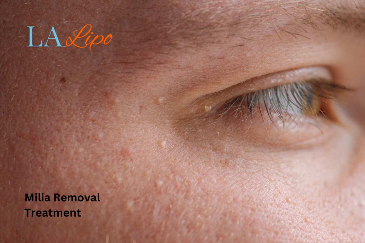 Cryopen Milia Removal: Is It the Easiest and Safest Option Matlock?