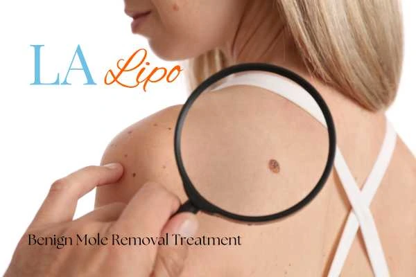 Why getting moles removed Matlock can boost your confidence!