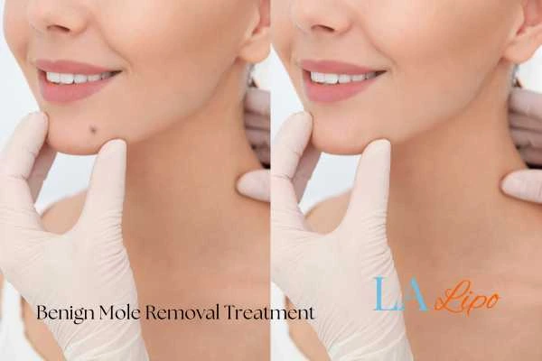 woman's before and after mole removal Matlock results