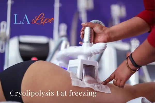women getting fat freezing Matlock