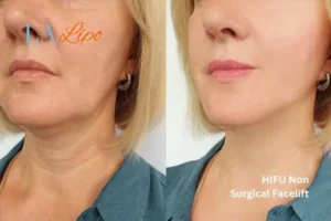 hi-fu for wrinkles Matlock before and after results