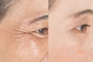 Before and after results of woman - HI-fu wrinkles reduction treatment Matlock