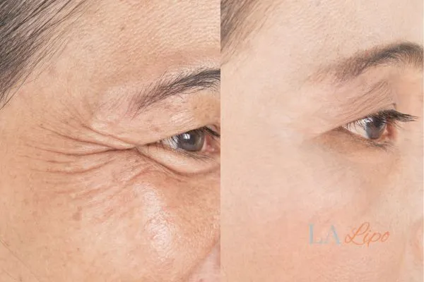 Before and after results of woman - HI-fu wrinkles reduction treatment Matlock