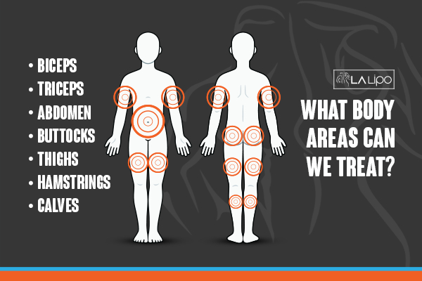 Graphic to show areas you can have LA-EMS Body Sculpting Matlock treatment.