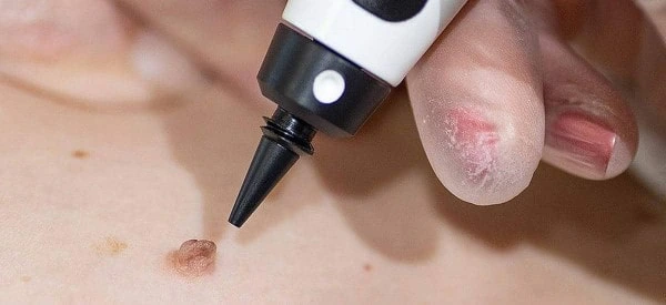 skin tag removal using cryopen Matlock