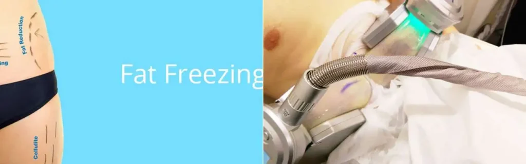 Fat freezing Matlock on multiple areas of the body