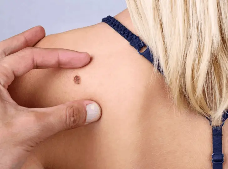 woman having mole removal Matlock consultation before treatment.