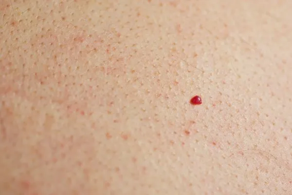 close up of a cherry angioma Matlock