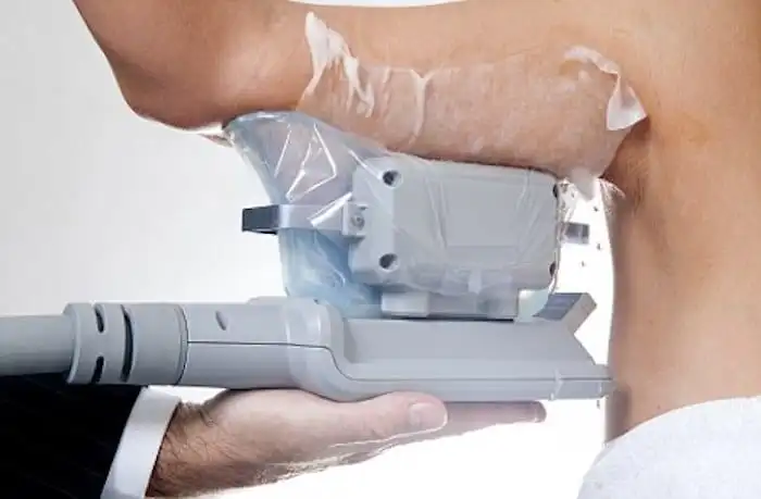 Picture of fat freezing Matlock on the upper arms.