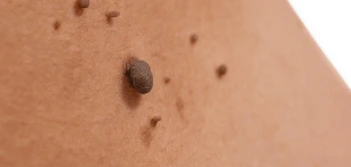 image of a skin tag Matlock