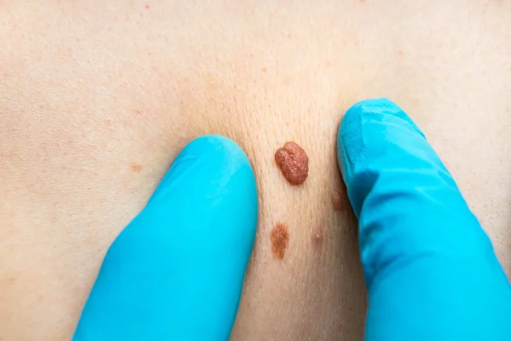 Consultant examining a skin tag Matlock