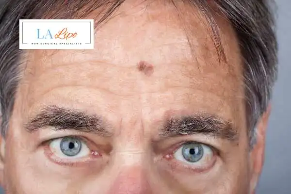 Solar Lentigo Removal Matlock image of man with mark on his forehead