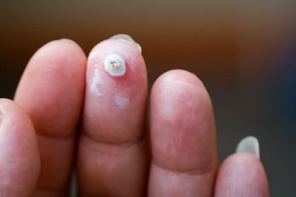 wart on person finger - cryotherapy to treat from LA LIPO Matlock
