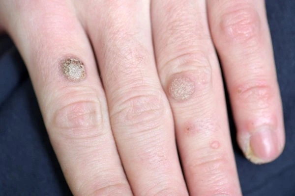 photo of warts on person hand - see wart removal Matlock from LA LIPO