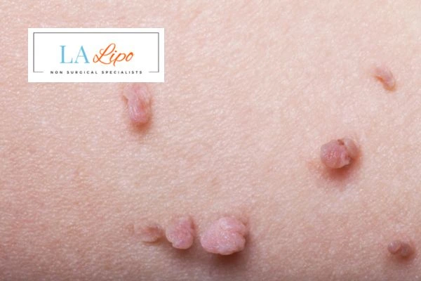 Does cryopen skin tag removal Matlock hurt? Find out now call our team today!