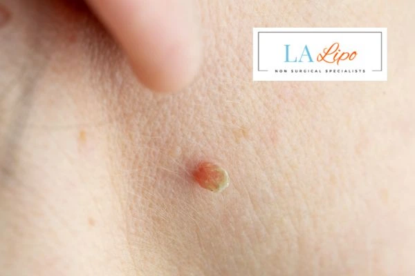 Book skin tag removal Matlock today speak to our team now!