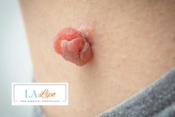 Interested in skin tag removal Matlock? Concerned about the pain? Find out more today!