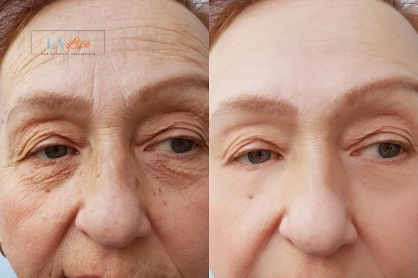 The powerful benefits of Morpheus8 Treatment Matlock - Call Our team today!