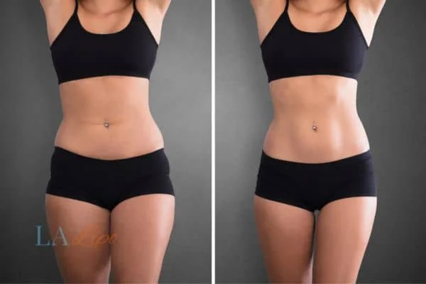 before and after results of non-surgical treatment to help a woman's body image and mental health Matlock