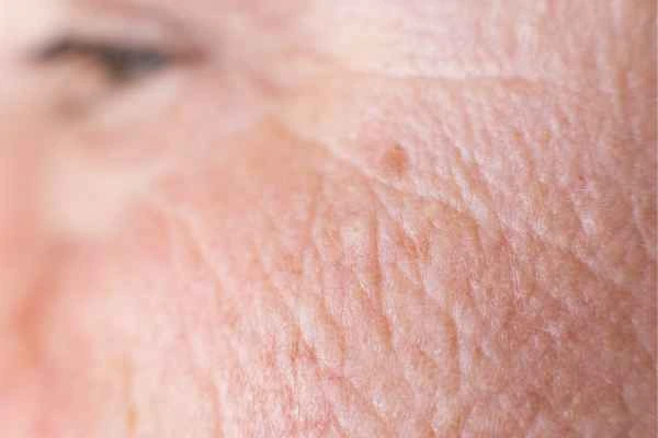 close up picture of a woman's face showing an age spot Matlock
