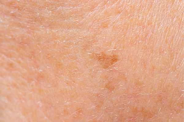 close up picture of age spots Matlock