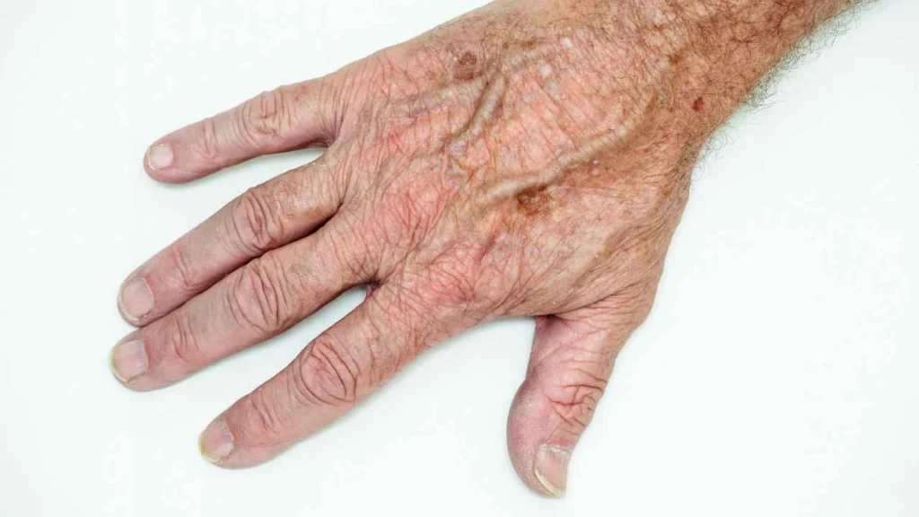 Male hand showing age spot Matlock
