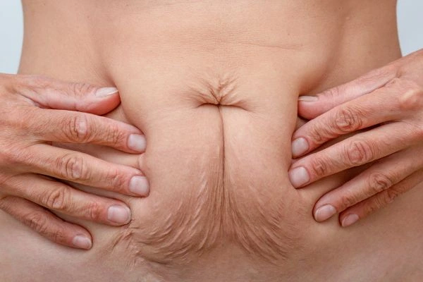 Image of a woman's stomach with loose skin - example of skin tightening Matlock options