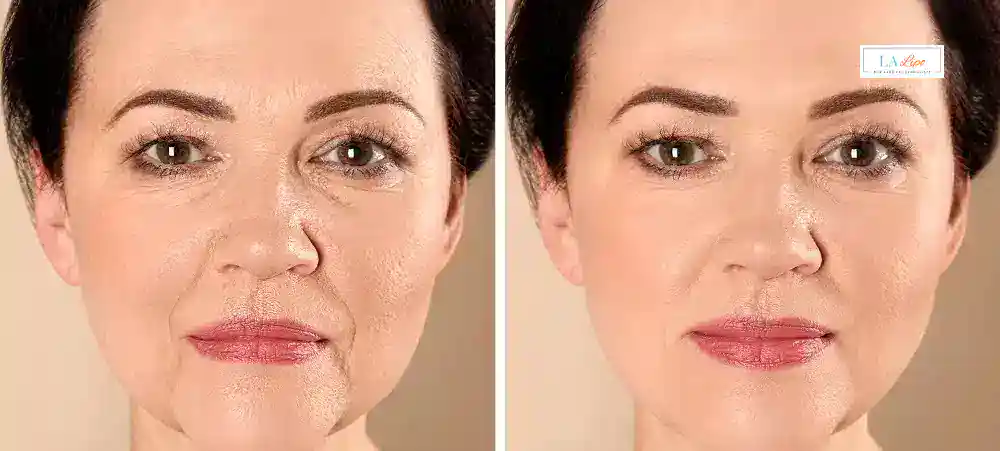 How Long Does It Take to See Results and How Long Do They Last Matlock?
