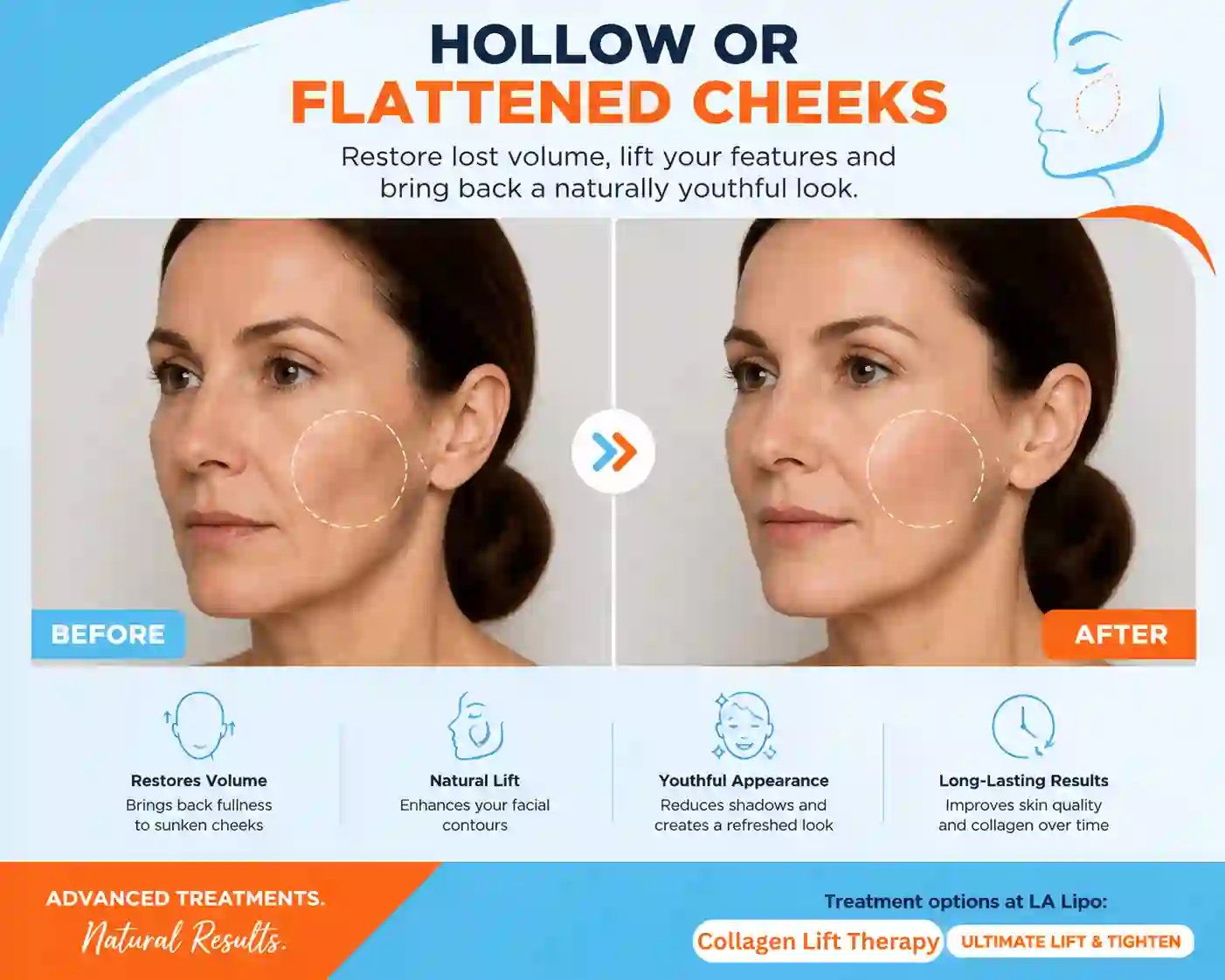 Sign #4: Hollow or Flattened Cheeks Matlock