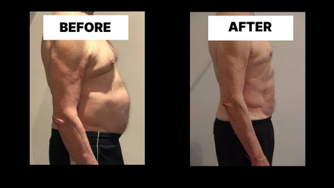 What Symptoms Can Diastasis Recti Cause in Men? Weak Core, Back Pain and Poor Posture Matlock